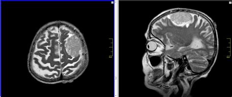 Snímka MRI mozgu matky a dieťaťa