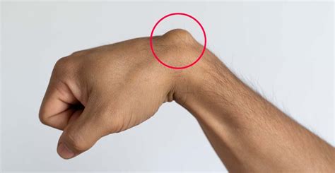 Ruka s viditeľným gangliónom na zápästí