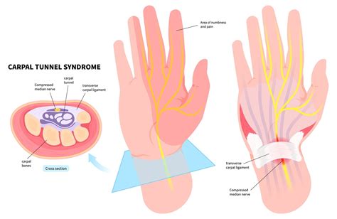 Schematické znázornenie karpálneho tunela a nervu