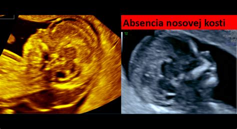 Zobrazenie plodu počas morfologického ultrazvuku