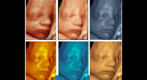 3D zobrazenie tváre bábätka počas ultrazvuku