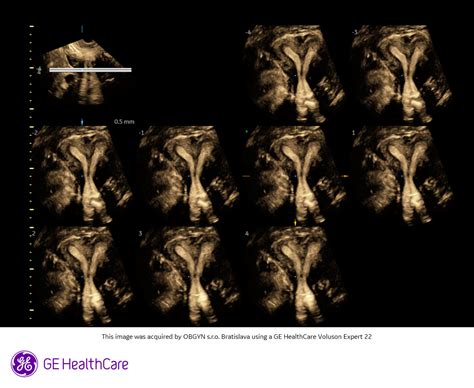 ultrazvukové vyšetrenie maternice s myómom
