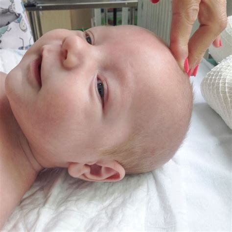 novorodenecká fontanela