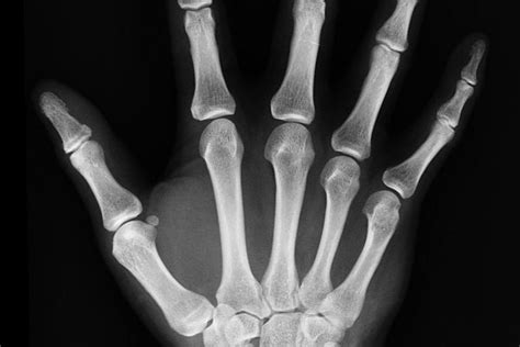 Röntgenový snímok pľúc dieťaťa s bronchopulmonálnou dyspláziou