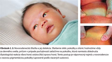 Diagram vysvetľujúci príčiny novorodeneckej žltačky