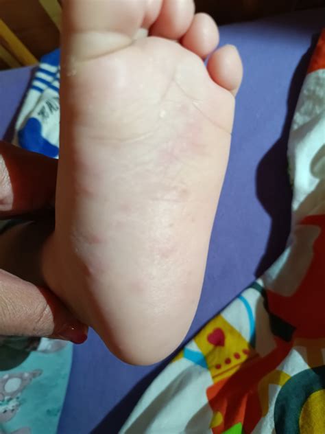 Ilustrácia dieťaťa s vyrážkami