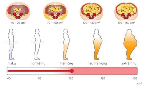 Diagram znázorňujúci vznik zrastov po chirurgickom zákroku v brušnej dutine