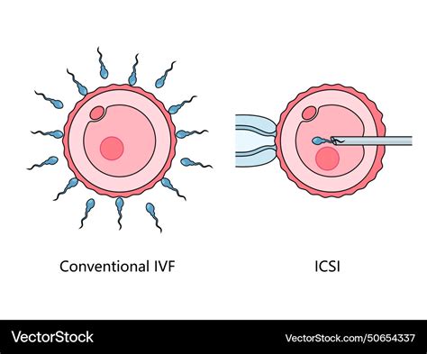 Diagram porovnávajúci IVF a ICSI
