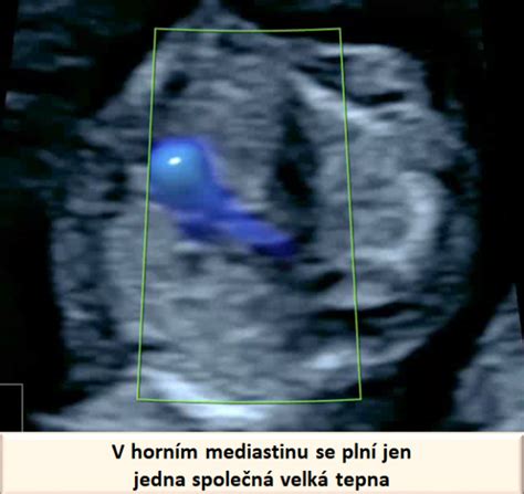 Sledovanie pohybov plodu