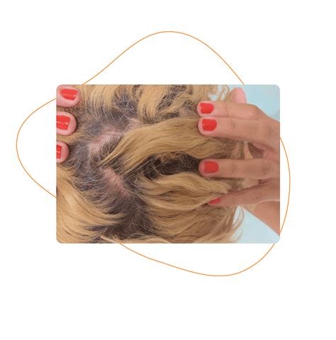 Ilustrácia ženských vlasov so symbolom vypadávania