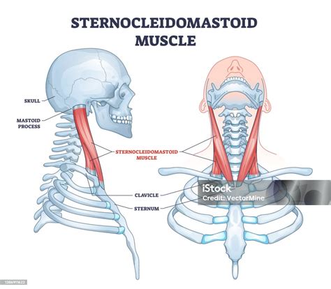 Diagram znázorňujúci torticollis a postihnutý sval krku