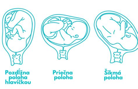 Ilustrácia pohybov plodu v maternici