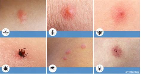 Infografika s tipmi na prevenciu uštipnutia hmyzom