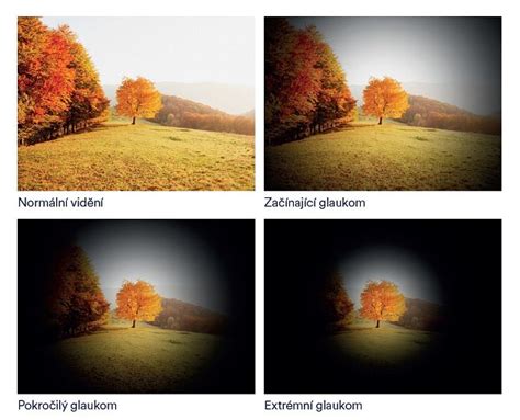 Ilustrácia rôznych príznakov sivého zákalu - rozmazané videnie, haló okolo svetiel, zhoršené farebné vnímanie