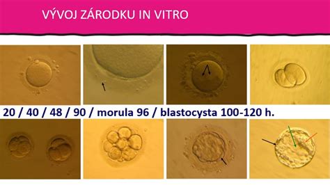 Zobrazenie gestačného vaku a zárodku na ultrazvukovom prístroji