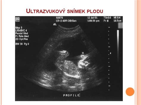 Detailný ultrazvukový obraz tváre plodu