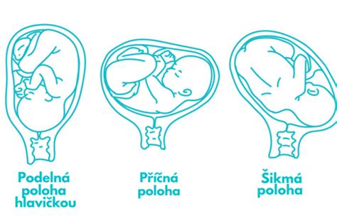 Grafické znázornenie polohy plodu v maternici