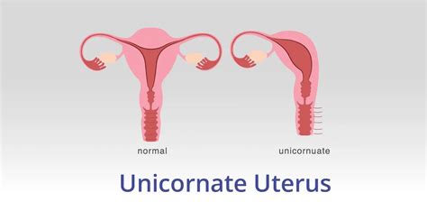 Ilustrácia uterus unicornis s rudimentárnym rohom