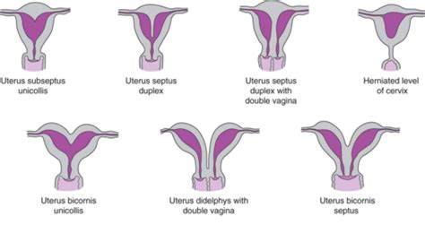 Schéma uterus bicornis