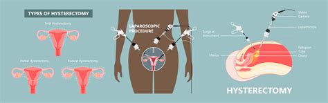 Rôzne typy hysterektómie