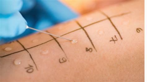 Ilustrácia dieťaťa podstupujúceho kožný prick test