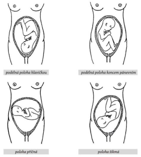 Diagram znázorňujúci polohy plodu v maternici