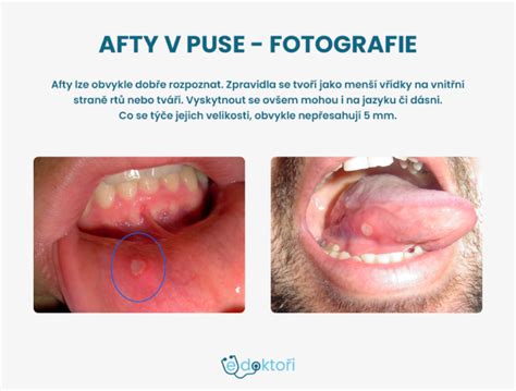 Detail vyrážok v ústach - afty