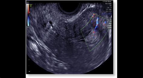 Ultrazvukové zobrazenie dvojrohej maternice