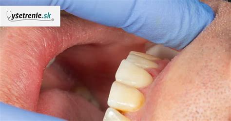 Ilustrácia zubného povlaku a baktérií