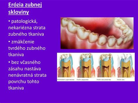 Schéma erózie zubnej skloviny