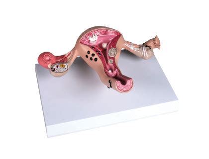 ilustrácia implantácie vajíčka do steny maternice