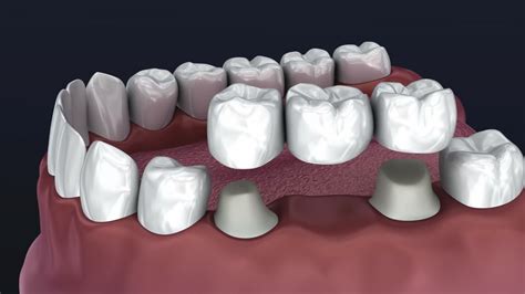 Zubný oblúk s prerezávajúcimi sa zúbkami