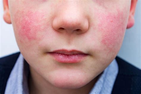 Ilustrácia dieťaťa s horúčkou, ukazujúca červené líca a horúce čelo