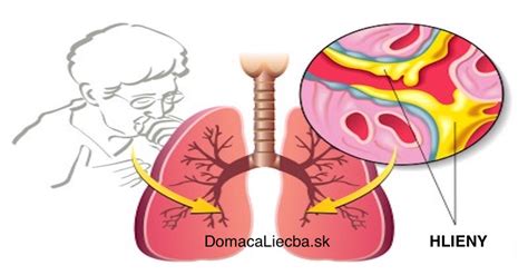 Diagram zobrazujúci zatekanie hlienov do nosohltana