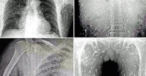 Röntgenový snímok brucha s naznačeným cudzie teleso