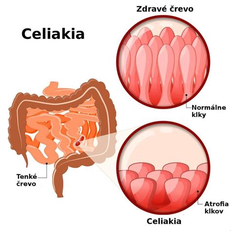 schematické znázornenie refluxu u dojčaťa