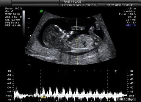 ultrazvuk plodu v 12 týždni