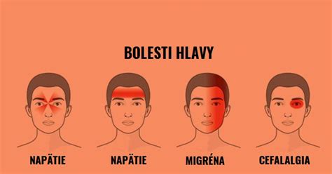 Ilustrácia rôznych typov bolestí hlavy