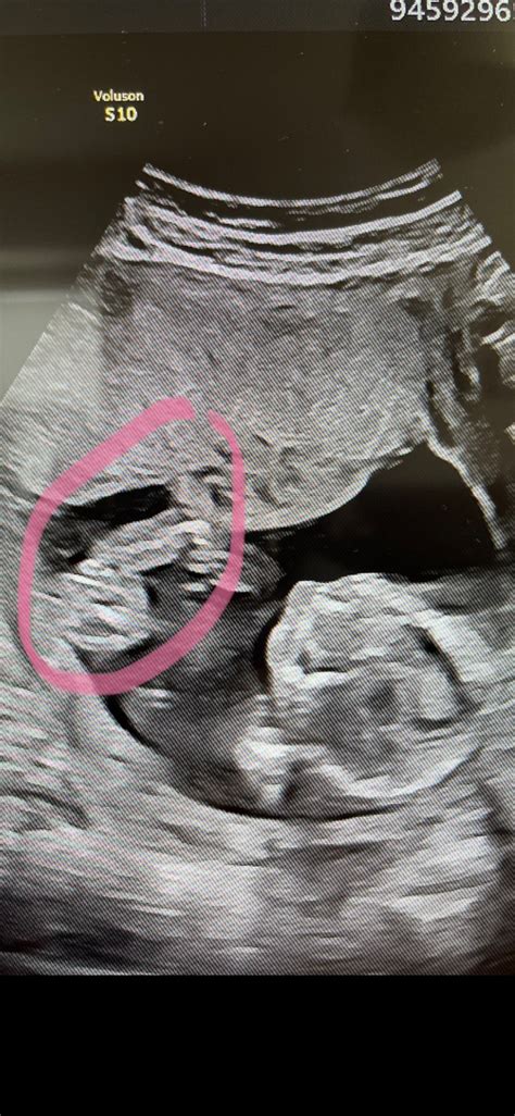 Ilustrácia odberu vajíčok pomocou ultrazvuku