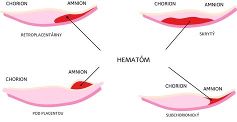 Ilustrácia rôznych typov krvácania v tehotenstve