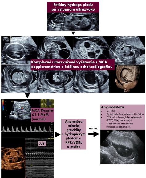 Ilustrácia ultrazvukového vyšetrenia panvy