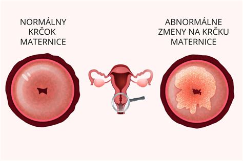 Ultrazvukový snímok tehotnej maternice s označeným hematómom