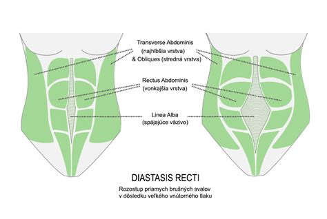 diagram zobrazujúci diastázu brušných svalov