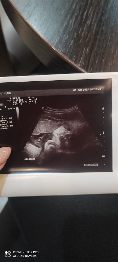 ultrazvukové zobrazenie plodu v 18. týždni tehotenstva