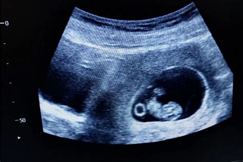 ultrazvuk tehotenstvo