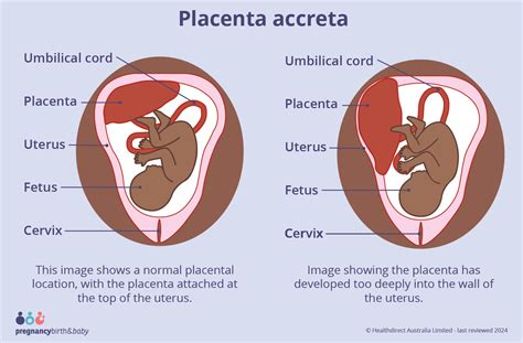 diagram znázorňujúci rôzne typy placenty accreta