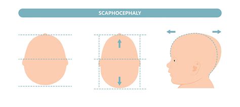 grafika znázornujúca symetrickú a asymetrickú hlavičku bábätka