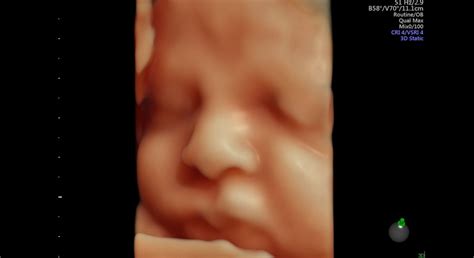 Zobrazenie plodu v maternici v treťom trimestri