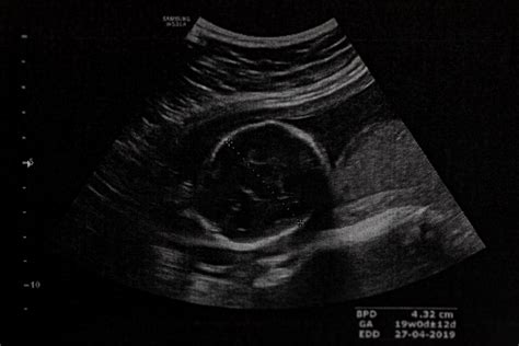 Ultrazvuk plodu v tehotenstve