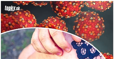 Infografika o prenose vírusu osýpok